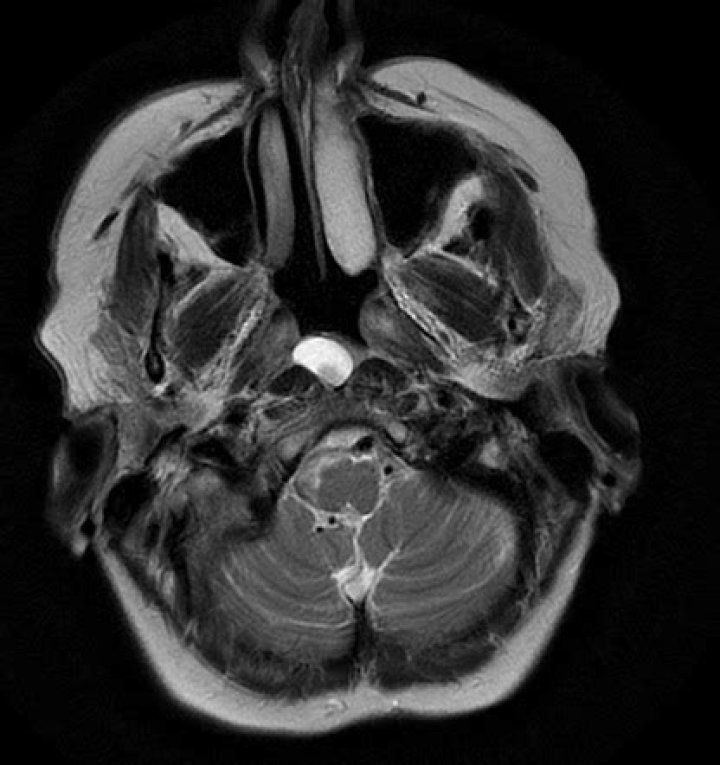 Is a Thornwaldt cyst dangerous?