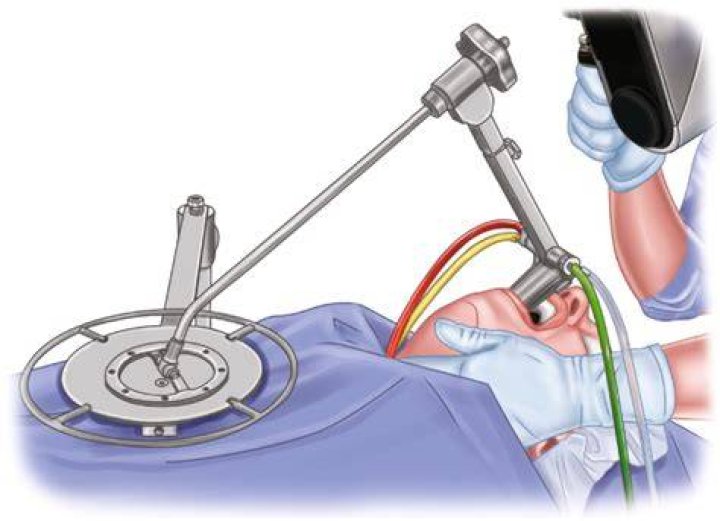 What is suspension Microlaryngoscopy?
